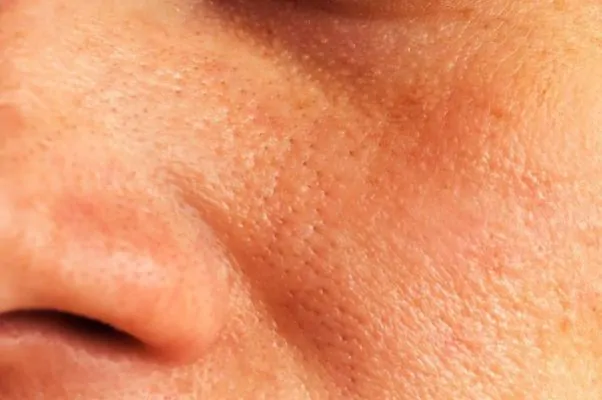 enlarged pores cheeks
