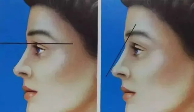 flat nose profile