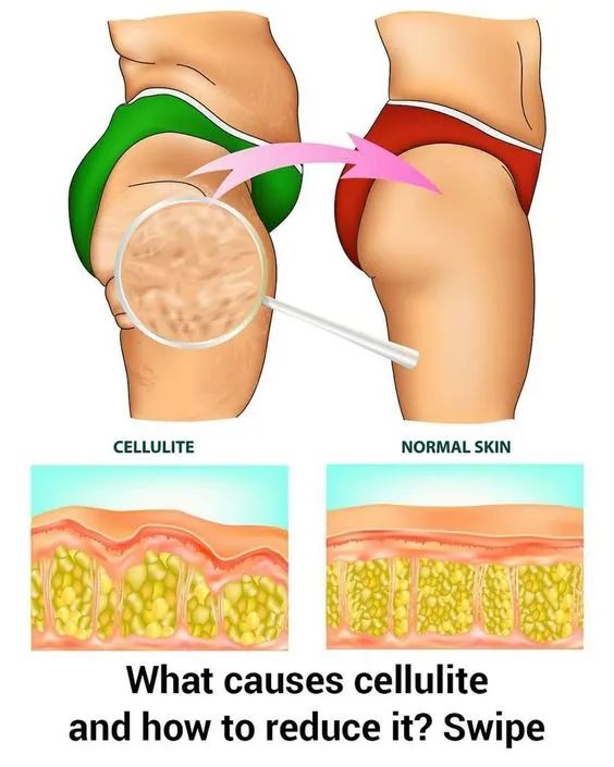 Cellulite on the Stomach: Causes and How to Get Rid of It